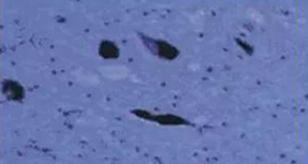 PD患者黑质神经元丧失