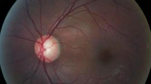 青光眼的克星来袭，，，，，助力患者远离视力的“窃贼”