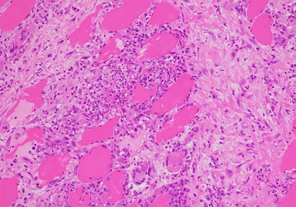 【yl23455永利助力】治疗结节病的KBMAB-16获FDA批准临床